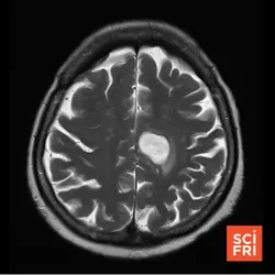 Why is brain cancer so hard to treat?